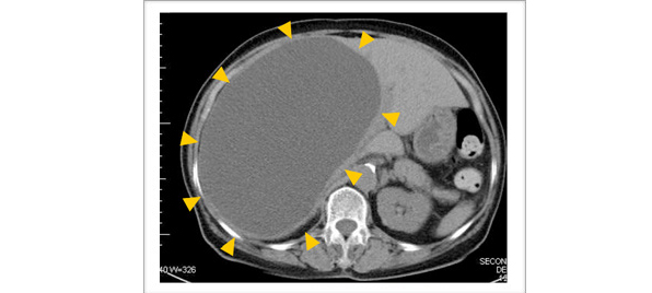 肝嚢胞のct撮影画像