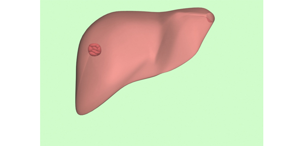肝血管腫のcgイラスト画像